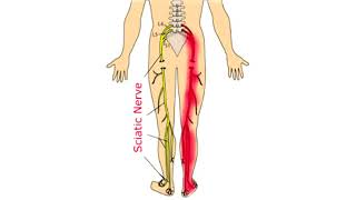 What Causes Sciatica and Can You Get Rid of It?  Sciatica Explained in 4 minutes. Profile