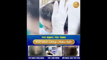 #Rụng tóc mà không lo chữa trị và cái kết !