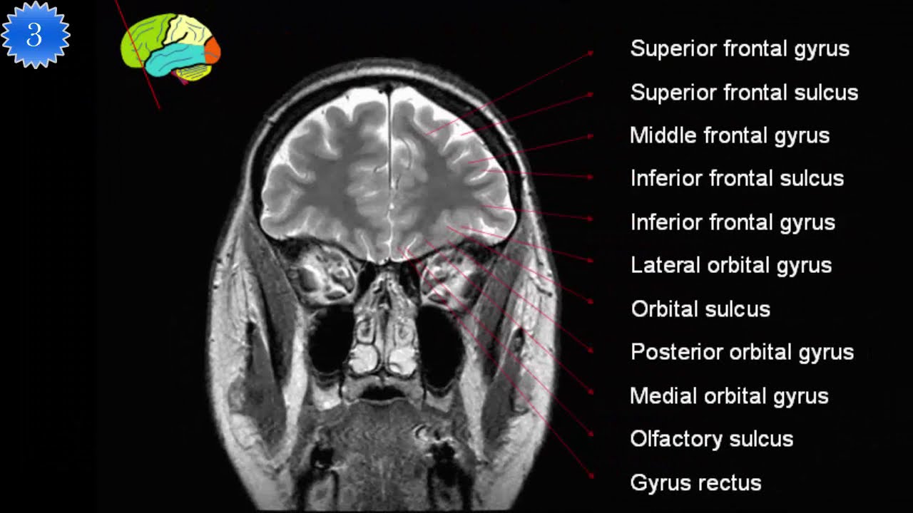 MRI Brain Anatomy Coronal T2 YouTube