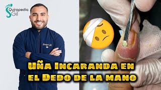 UÑA INCARNADA EN EL DEDO DE LA MANO 😱