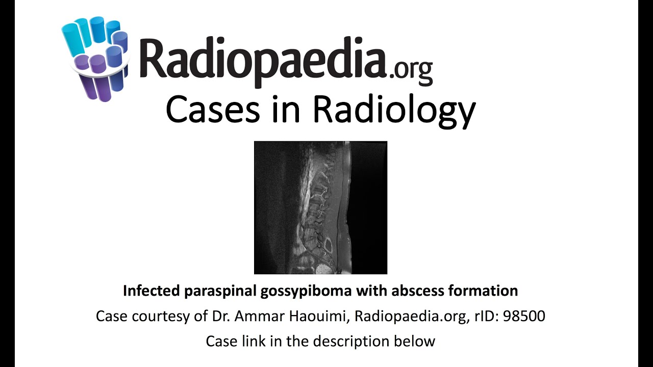 Infected paraspinal gossypiboma with abscess formation (Radiopaedia.org) Cases in Radiology