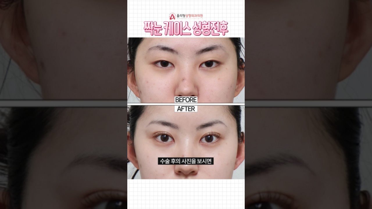 [Thẩm mỹ viện Oliting] Khắc phục mắt lệch! Tiết lộ hình ảnh trước và sau phẫu thuật! #reviewphauthuat #shorts #vande #issue