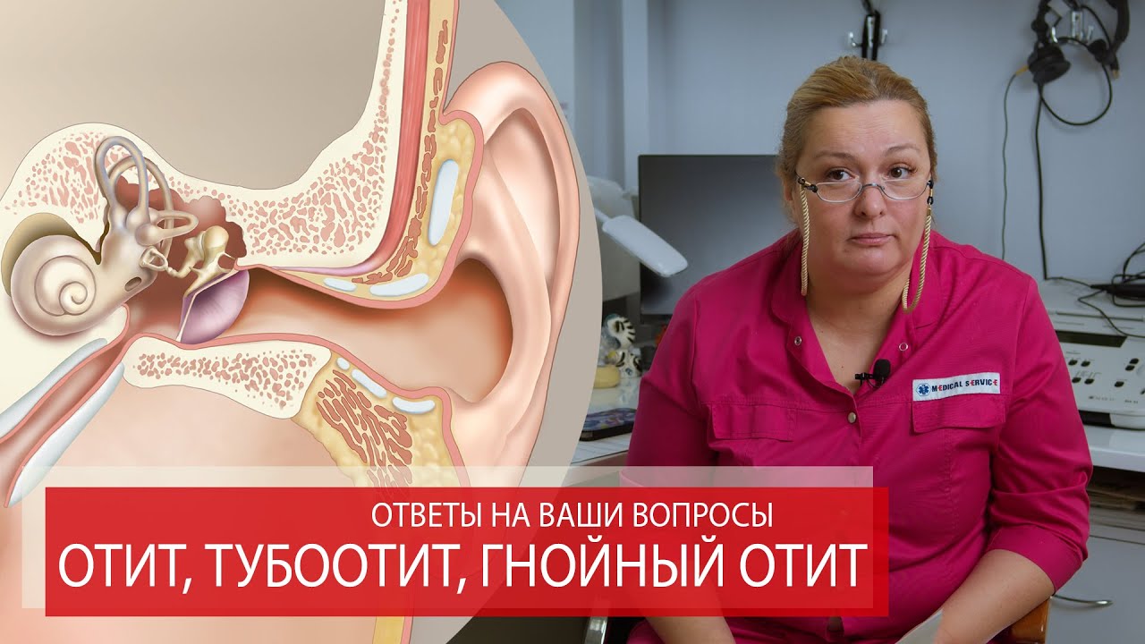 Дисфункция слуховой трубы. Лечение евстахиита у взрослых.