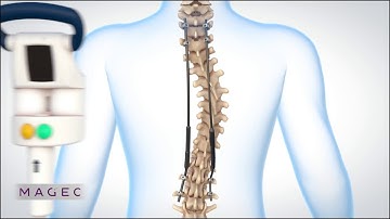 MAGEC® – Ferngesteuerte Technologie für die Behandlung der kindlichen Skoliose