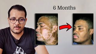 OPZELURA ( Ruxolitinib ), finally a cure for VITILIGO !!