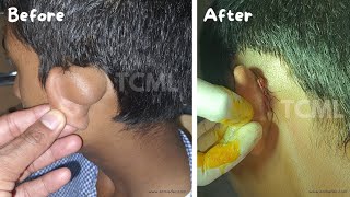 Post auricular dermoid | Dermoid Cyst