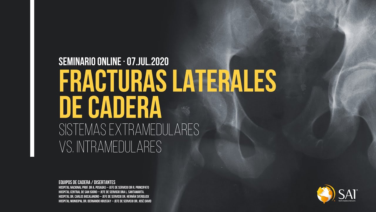 Sistemas Extramedulares VS Intramedulares en Fracturas Laterales de Cadera | South America Implants