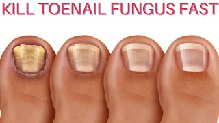 kill toenail fungus fast