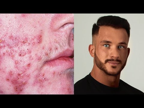 Video: 4 způsoby, jak se zbavit suché pokožky na obličeji