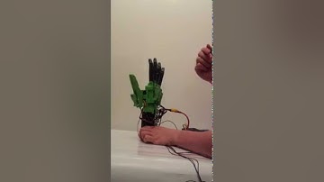 First Prototype Bionic Hand for a Transradial Ampute