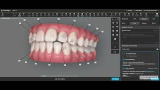 Invisalign Optimized Attachments vs. Larger Attachments