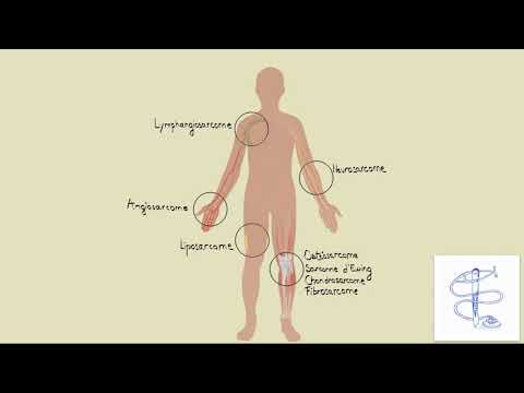 Vidéo: Tumeurs Des Tissus Mous - Symptômes Et Traitement