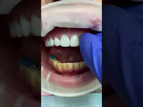 Видео: Установка виниров E-max. #emaxveneers #виниры