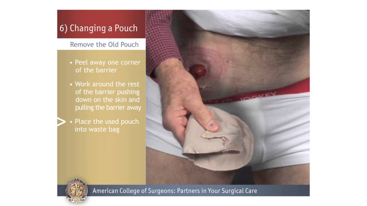colostomy bags • Archives Spotlight