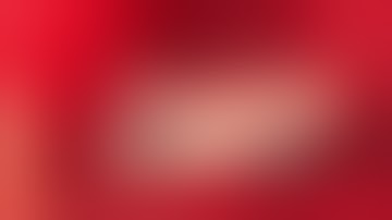 Bi Directional Augmentation of Double Arched Posterior Maxillary