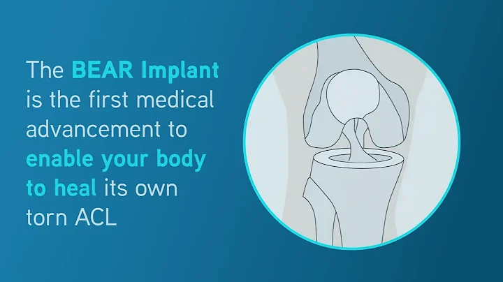 BEAR Implant Animated Infographic | Miach Orthopaedics