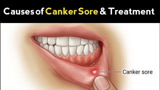 What Causes of Canker Sores and Treatment || Mouth Ulcer