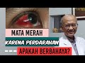 Mata Merah Karena Perdarahan, Apakah Berbahaya? | dr. Basuki Rokhmad SpM