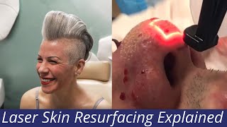 Laser Resurfacing Explained [ How Lasers (and some non-lasers) Work to Remodel & Resurface the Skin]