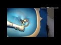 Endodontic retreatment - The access