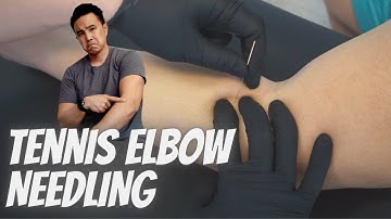 GOODBYE tennis elbow - Dry needling trigger point twitch response at the elbow