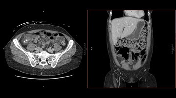 Abdominal Imaging Call Prep Cases: Acute Uncomplicated Appendicitis (CT) Search Pattern