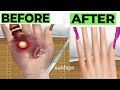 Asmr treatment for your injured finger