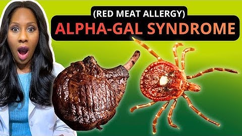 WHAT IS ALPHA-GAL SYNDROME? WHAT ARE ALPHA-GAL SYNDROME SYMPTOMS? A Doctor Explains 