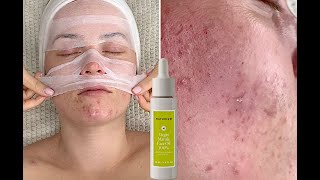 Oily, Pimples & Clogged Pores At-Home Facial {Affordable Luxury Skincare} with NATURIUM