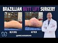 Brazilian Butt Lift Surgery and Pre-Op Example | Brown Plastic Surgery