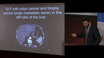 SAT - 19 - Interventional Oncology: Liver Directed Therapies (Gonzalez Beicos)