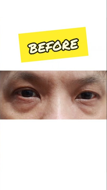 Cara Menghilangkan Kantung Mata, Mata Panda dan Bintik dibawah Mata.