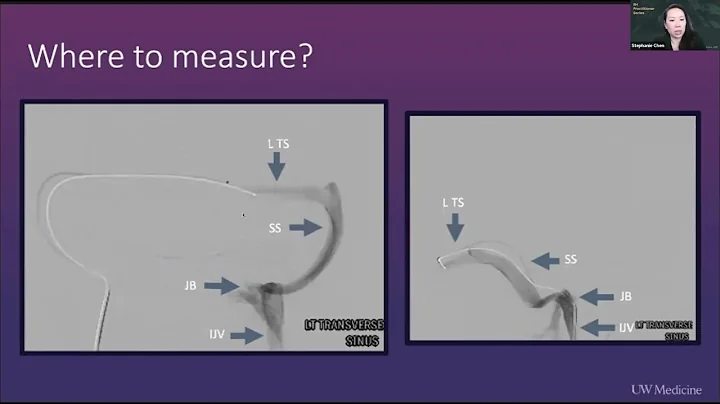 Where To Measure Pressures for Venous Manometry for IIH