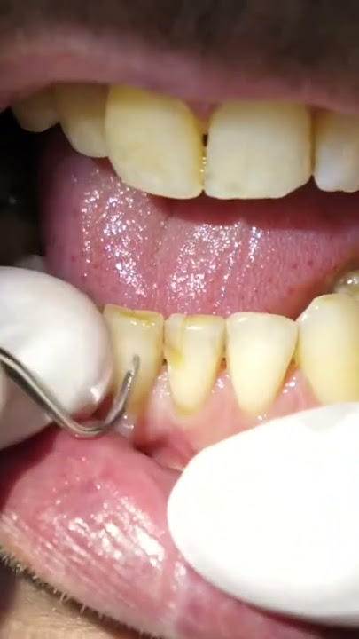 smoker’s teeth dental cleaning #shorts