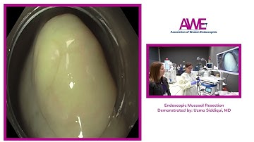 Endoscopic Mucosal Resection Demonstrated by Uzma Siddiqui, MD