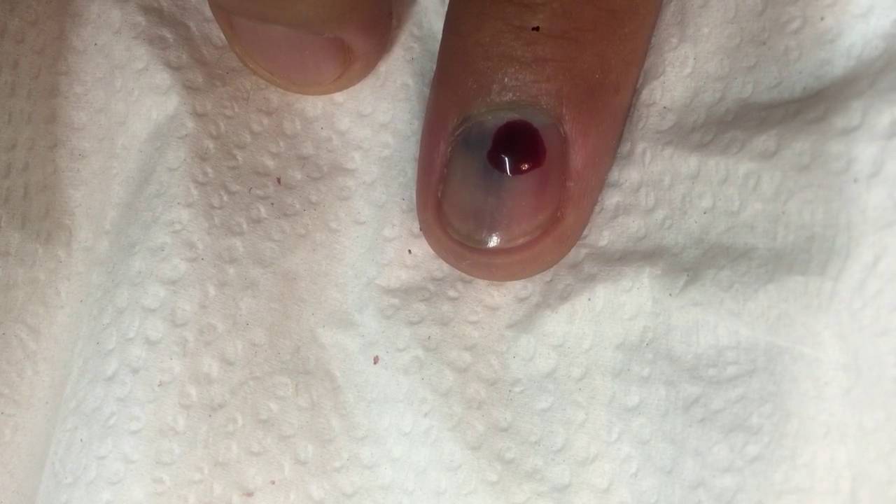 Me machuque un dedo que hago - YouTube