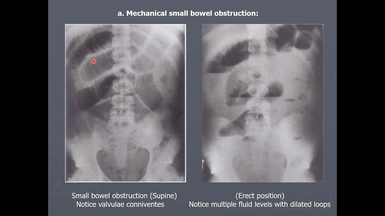Gastroenterology and nutrition, Plain abdominal x ray, Dr. Mai Emara