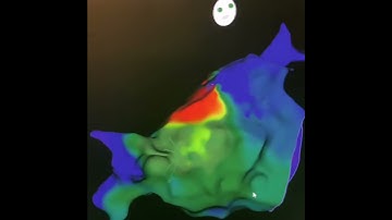 3 dimensional movement of heart arrhythmia