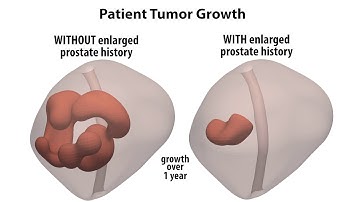 Simulation: Tumor Growth with/without Enlarged Prostate History