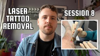 Laser Tattoo Removal | Session 8 | Before & After