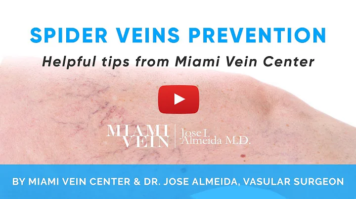 Guide to Spider Veins Prevention by the Miami Vein Center
