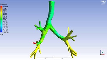 CFD through healthy lung airway - Pressure contours on the surface