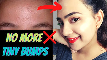 7 Days Challenge 😲 Treat TINY BUMPS on FOREHEADS/FACE NATURALLY | 100% Works Home Remedy