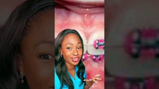Is pink a good braces color #shorts30 #bracescolors #teeth
