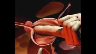 adenomectomie voie haute