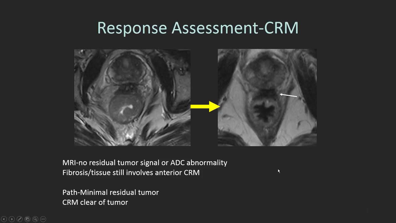 rectal tumor