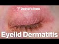 Eyelid Dermatitis: Causes, Treatment, and Prevention | Dermatologist Explains