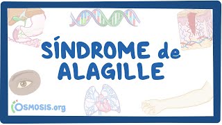 NORD - Alagille Syndrome (Spanish)