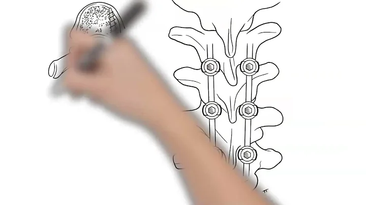 Scoliosis Surgery Explained | Gillette Children's