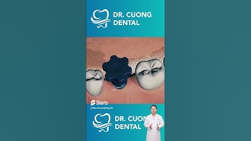 Trồng implant răng hàm sẽ như thế nào? |Dr Cường Official